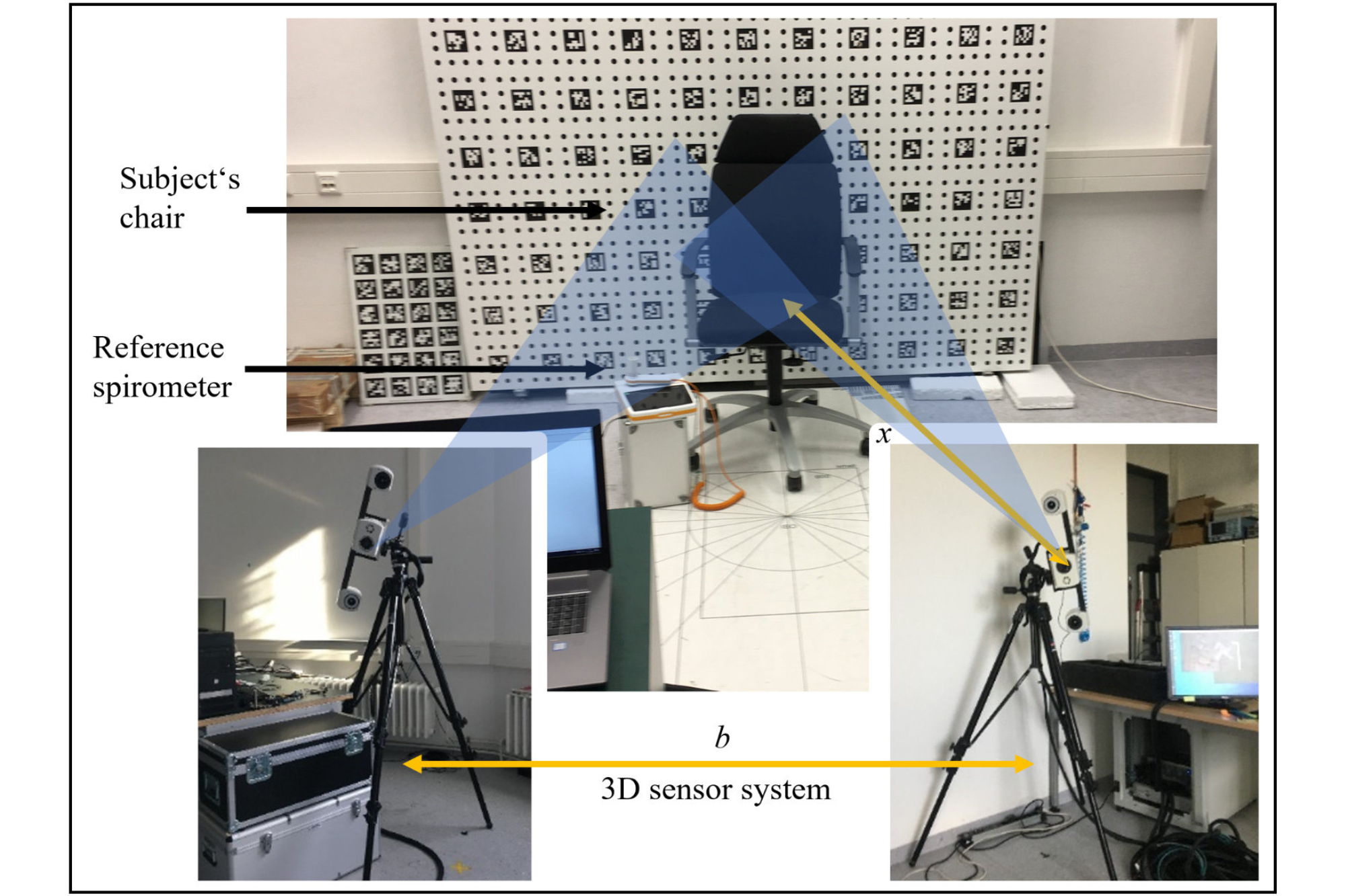 A 3D sensor network consisting of two 3D sensors for contactless measurement of the tidal volume by time-resolved 3D measurement of the torso volume of a patient.
